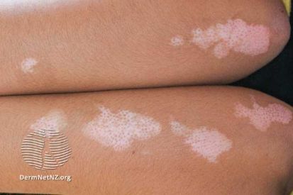 vitiligo-0010__WatermarkedWyJXYXRlcm1hcmtlZCJd