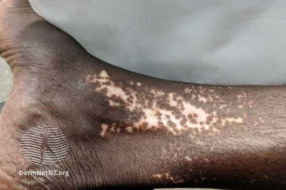vitiligo-0012__WatermarkedWyJXYXRlcm1hcmtlZCJd