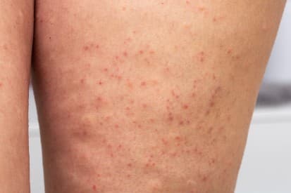 pinnacleskin.com /conditions/keratosis-pilaris Carousel 1 Image 7