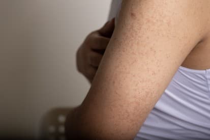 pinnacleskin.com /conditions/keratosis-pilaris Carousel 1 Image 5