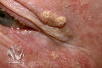 Seborrheic-Keratosis3