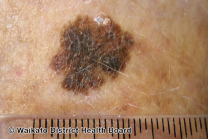 Melanoma-6