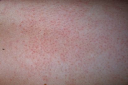 Keratosis-pilaris3