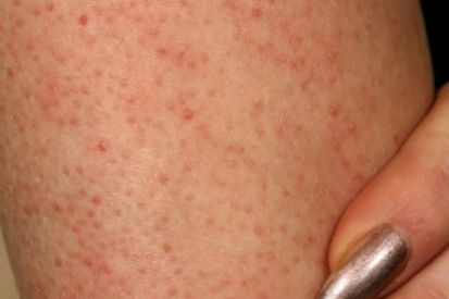 Keratosis-pilaris2