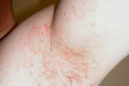 Pityriasis-Rosea5