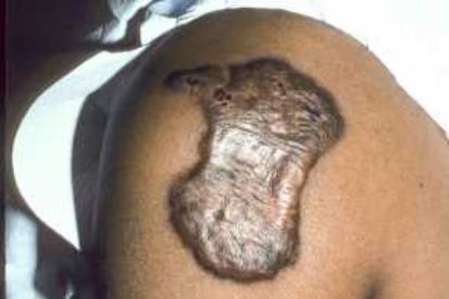 keloid2-(1)