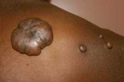 keloid5-(1)