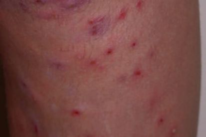 folliculitis2