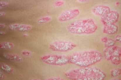 Psoriasis4