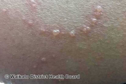 molluscum-contagiosum-skin-of-colour-00014__WatermarkedWyJXYXRlcm1hcmtlZCJd-(1)