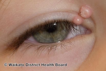 molluscum-contagiosum-eyelid__WatermarkedWyJXYXRlcm1hcmtlZCJd-(1)