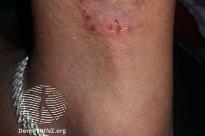 Ringworm5