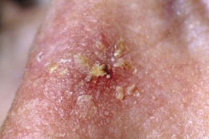 actinic-keratosis-3