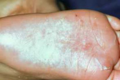 scabies-0044__ProtectWyJQcm90ZWN0Il0_FocusFillWzI5NCwyMjIsIngiLDFd